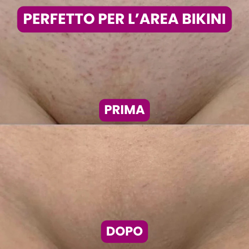 EpilThera™ – Depilatore Irelax CrystalSmooth™